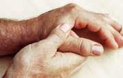 Osteoarthritis Flare-Up