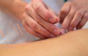 Acupuncture for Arthritis
