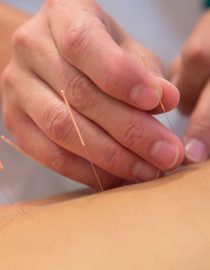 Does Acupuncture for Arthritis Work? Does Acupuncture for Arthritis Work?